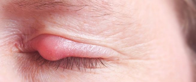 مرض شعيرة العين او شحاذ العين علاجات طبيعية للتخلص منه